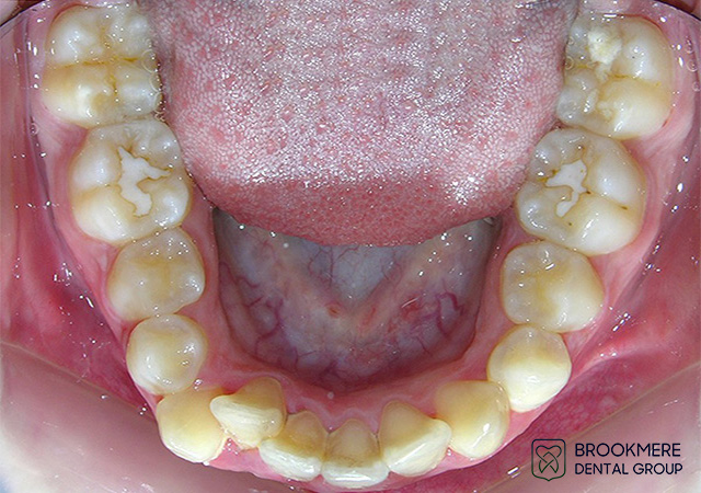Dental Treatment Photos Coquitlam