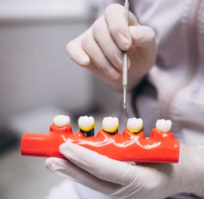 Dental-Crowns