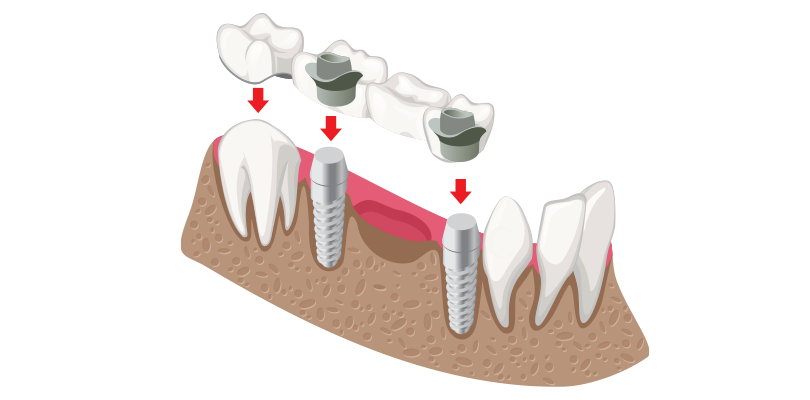 dental-bridges