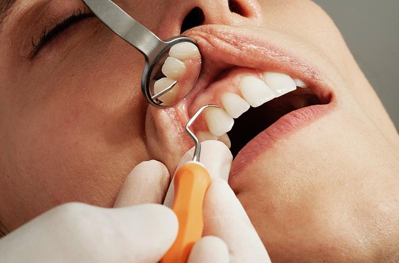 brookmeredental_blog_prevent_and_get_treatment_for_exposed_dentin_in_coquitlam