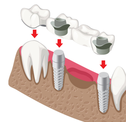 dental bridge
